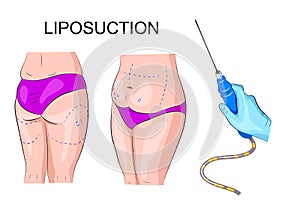 The female body and markings for liposuction