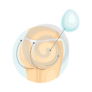 Female buttocks after correction of implants. Plastic surgery vector illustration