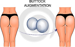 Female buttocks implants, buttock augmentation