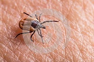 Female castor bean tick crawling on pink human skin. Ixodes ricinus