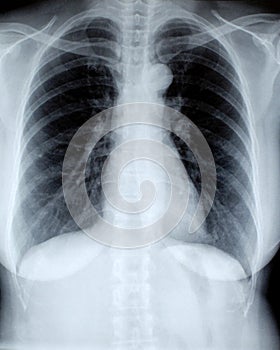 Female chest xray, front view