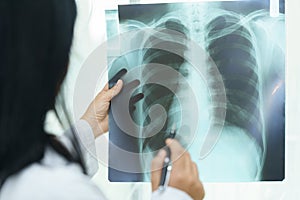 Female doctor examining about lungs with x-ray film - sick concept.