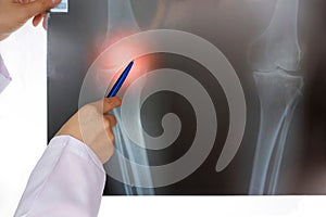 Female doctor`s hand using pen to pointing patient`s knee joins X-ray film on glowing screen in radiology orthopedic unit at