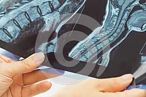 Female doctors hand pointing at x-ray medical imaging at a shoulder condition