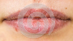 Female dry lips with herpes cold sore