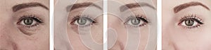 Female elderly eyes wrinkles before removal difference after lifting correction procedures