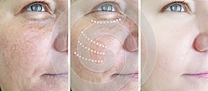 Female elderly rosacea removal wrinkles before after collage difference lift cosmetology mature