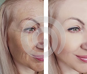 Female eye beauty wrinkles before and after dermatology antiaging regeneration treatments