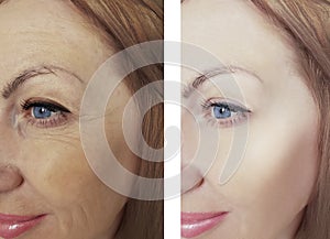 Female eye beauty wrinkles difference before and after dermatology antiaging regeneration treatments