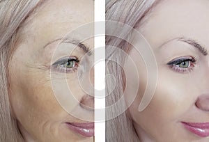 Female eye wrinkles before and after dermatology antiaging regeneration treatments