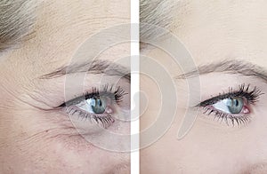 Female eye wrinkles before after effect difference lift cosmetology mature correction procedures