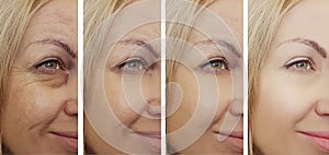 Female eye wrinkles before and after effect retouch collage cosmetology results treatments