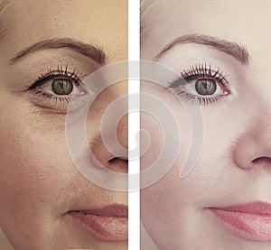 Female eye wrinkles before and after lift effect difference correction procedures