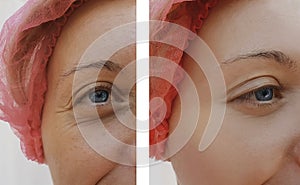 Female eye wrinkles before and after regeneration treatments