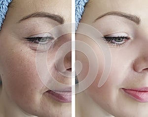 Female eye wrinkles before removal and after lift effect difference correction procedures