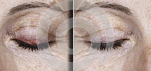 Female eyes showing a swollen red lump caused from a bacterial infection before and after treatme