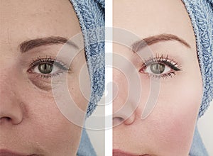 Female eyes wrinkles difference before and after treatment effect treatments