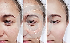 Female eyes wrinkles effect correction before and after treatments