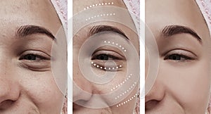 Female eyes wrinkles effect regeneration cosmetology removal correction before and after treatments