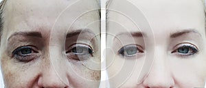 Female eyes wrinkles before and after procedures, bloating