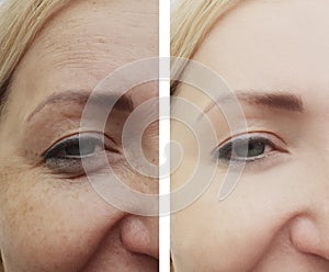 Female eyes wrinkles before and after procedures, bloating removal