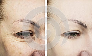 Female eyes wrinkles results before and after treatments