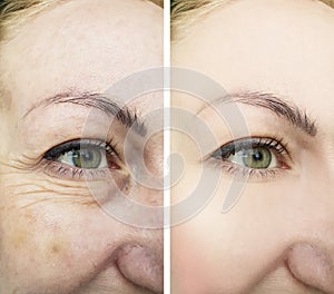 Female eyes wrinkles before and after treatments