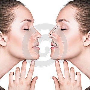 Female face before and after cosmetic nose surgery