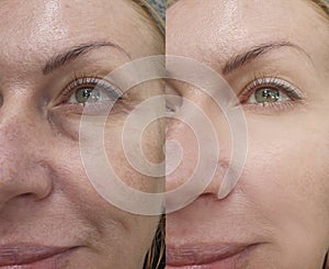 Female face wrinkles before and after  rejuvenation  treatment collage