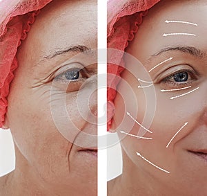 Female facial wrinkles treatment mature before and after cosmetic procedures, arrow