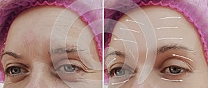 Female facial wrinkles treatment mature difference before and after cosmetic procedures, arrow