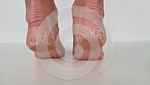 Female feet with cracks and peeling on heels isolated on a white background. Fungal skin infections, allergic diseases