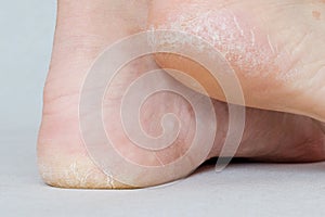 Female feet with dry heels, cracked skin