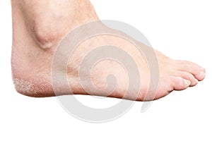 Female foot with cracked heel on white background