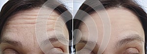 Female forehead wrinkles aging before treatment correction biorevitalization