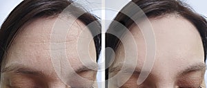 Female forehead wrinkles before treatment biorevitalization