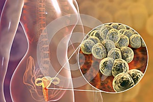 Female gonorrhea, medical concept