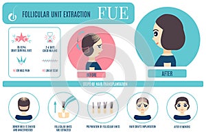 FUE hair treatment for women infographic poster photo