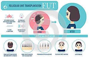 FUT hair transplantation for women