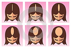 Female hair loss illustration