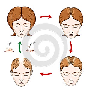 Female hair loss and transplantation icons