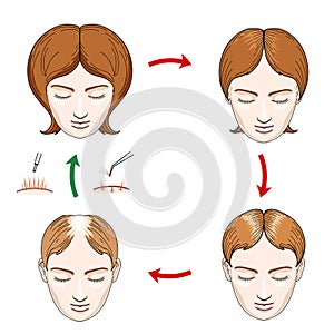 Female hair loss and transplantation icons photo