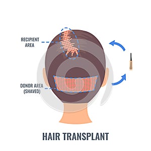 Female hair treatment with FUE transplantation method