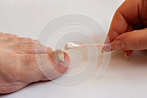 The female hand applies a cotton swab cream to the toenail affected by the fungus.