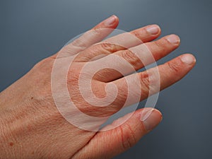 Female hand with dry atopic skin. White background. Close-up of the skin on the palm and fingers. Derma in need of care