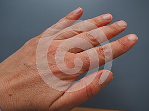 Female hand with dry atopic skin. White background. Close-up of the skin on the palm and fingers. Derma in need of care