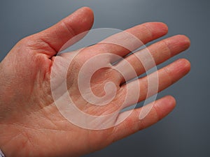 Female hand with dry atopic skin. White background. Close-up of the skin on the palm and fingers. Dermatological