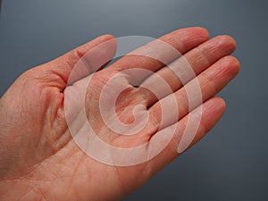 Female hand with dry atopic skin. White background. Close-up of the skin on the palm and fingers. Dermatological