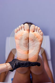 Female hand hold Feet with dry skin before treatment