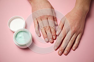 Female hands apply moisturizer to the skin. Irritation and allergies, frostbite